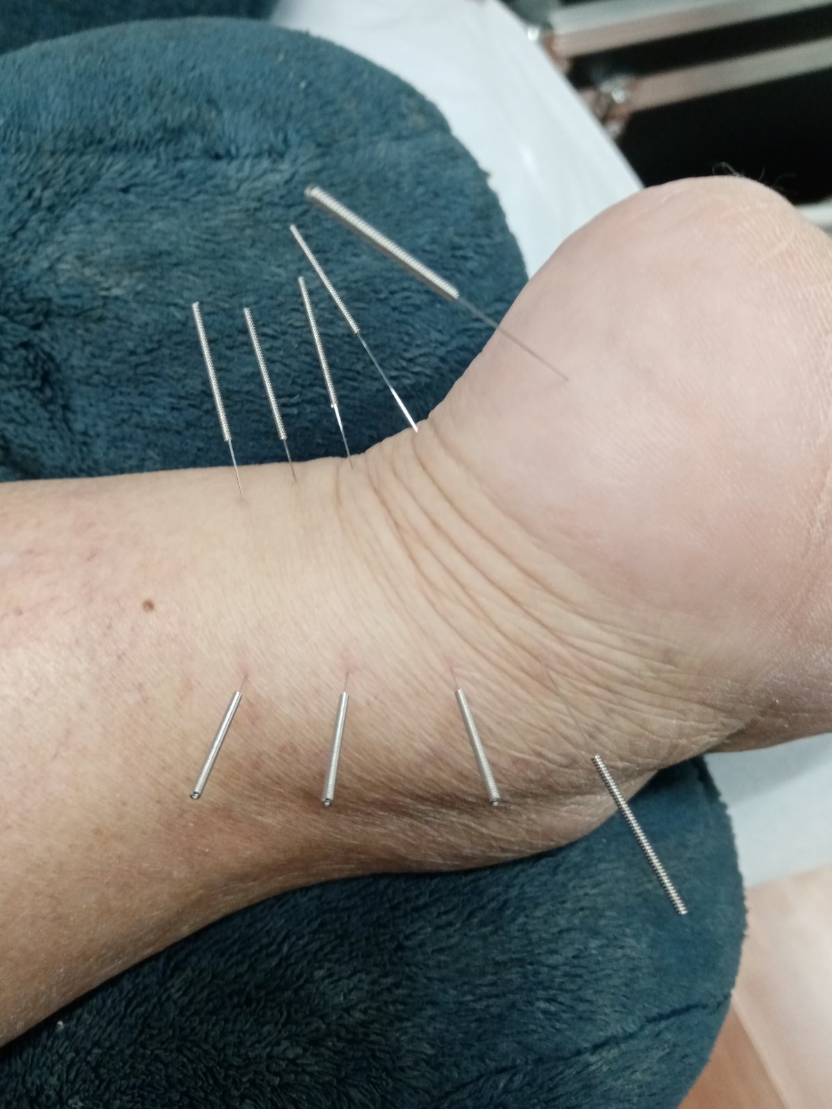 Βελονισμός - CM Physio