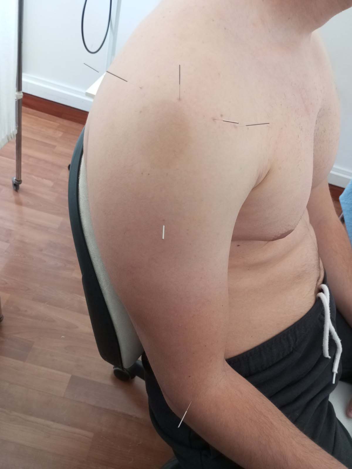 Βελονισμός - CM Physio