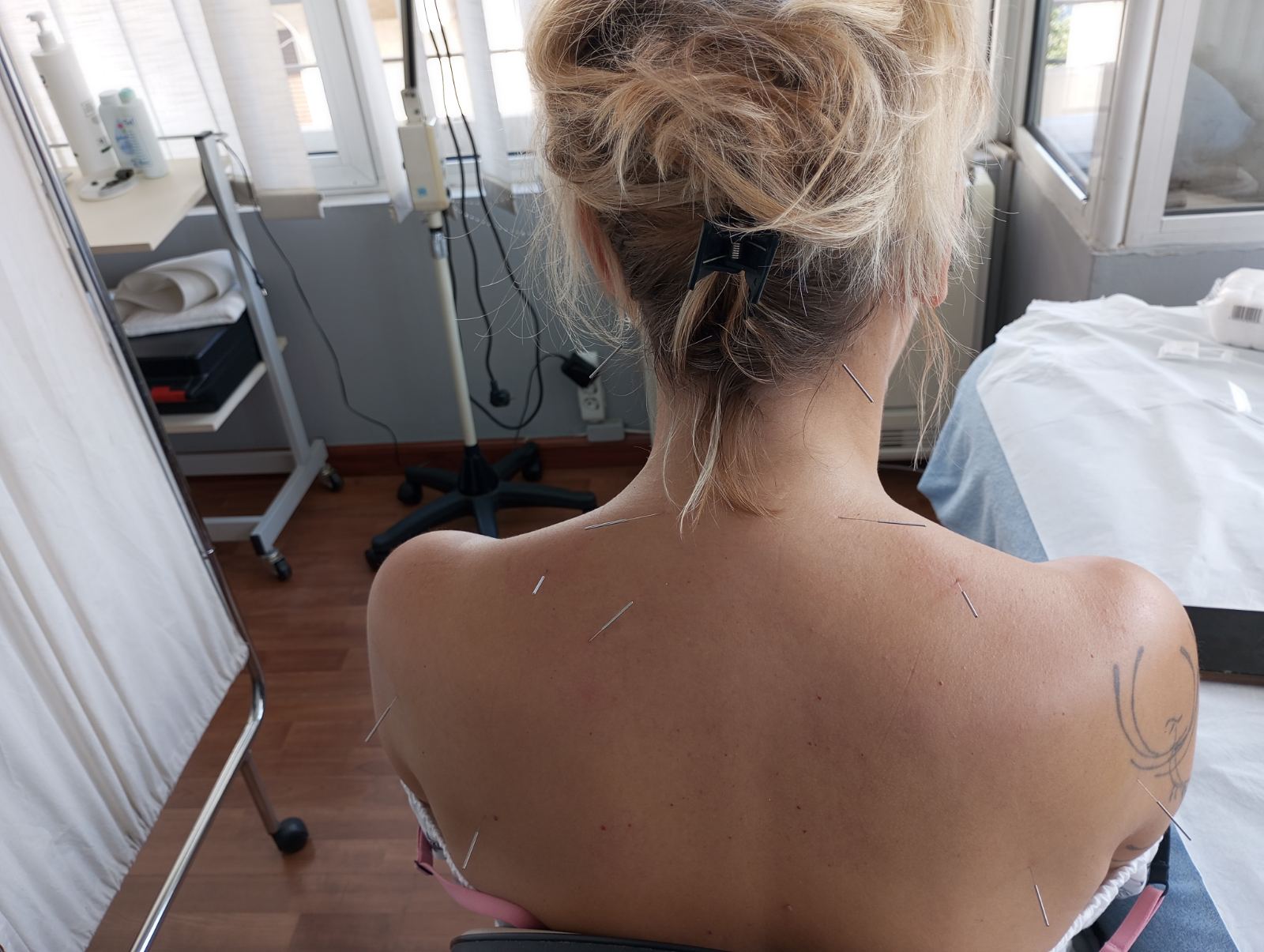 Βελονισμός - CM Physio